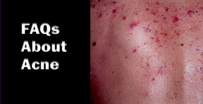 Acne FAQs