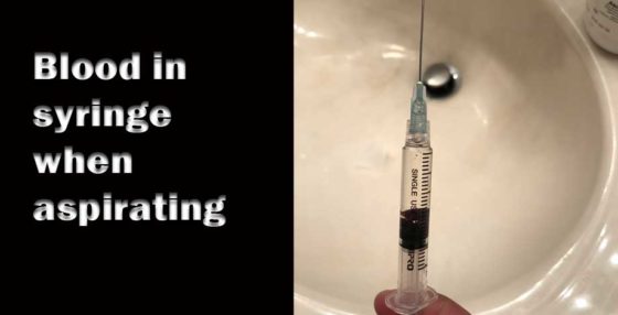 Blood in syringe when aspirating
