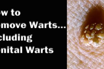 How to Remove Warts… Including genital warts
