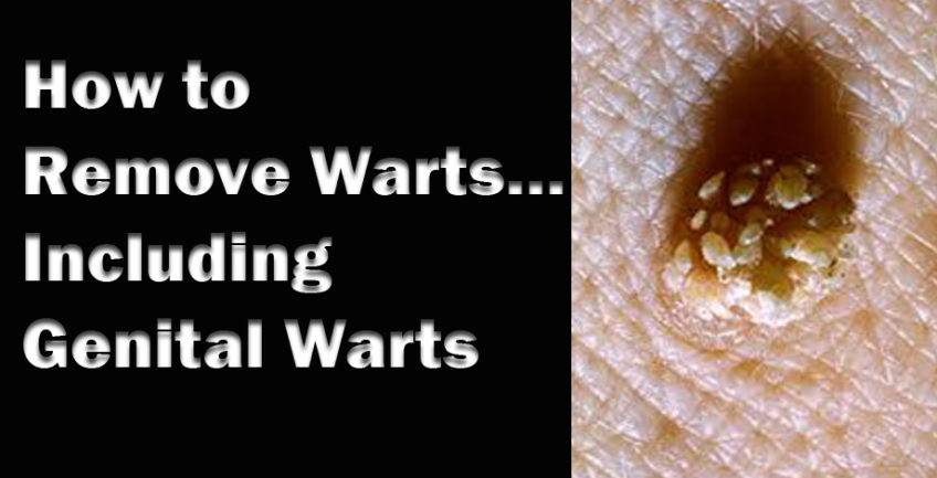 How to Remove Warts… Including genital warts
