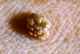 How to Remove Warts